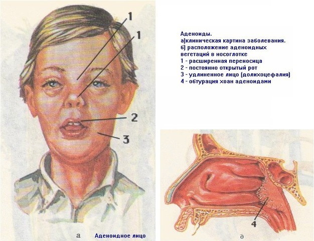 Rosto adenóide em uma criança, um adulto. Perfil fotográfico, rosto completo, tipo, aparência antes e depois da cirurgia, sinais