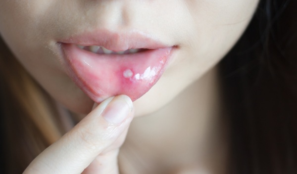 Herpes stomatitis. Treatment in adults, consequences, incubation period
