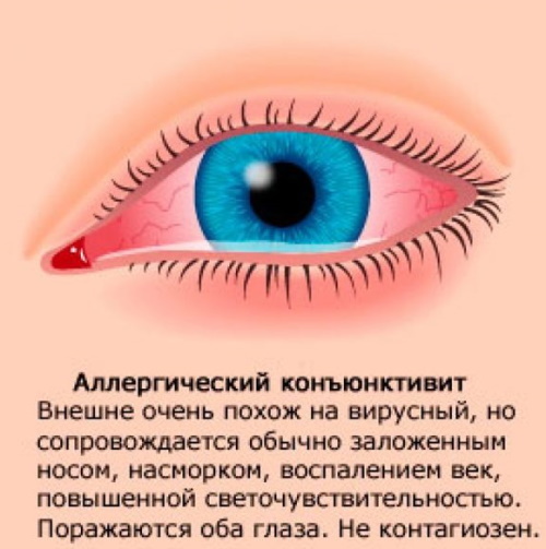 Kløende øyne. Årsaker og behandling, dråper