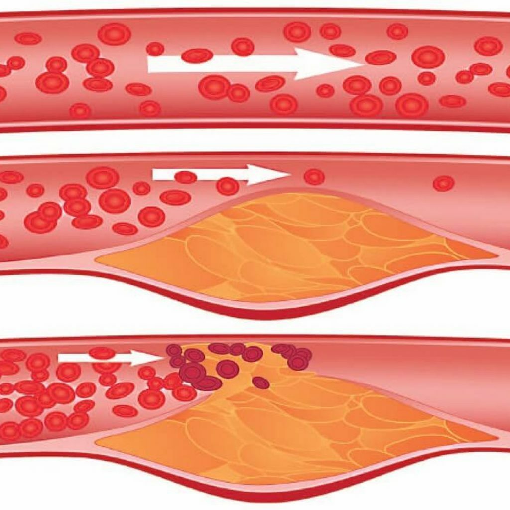 Esquema de formação de uma placa aterosclerótica em um vaso sanguíneo