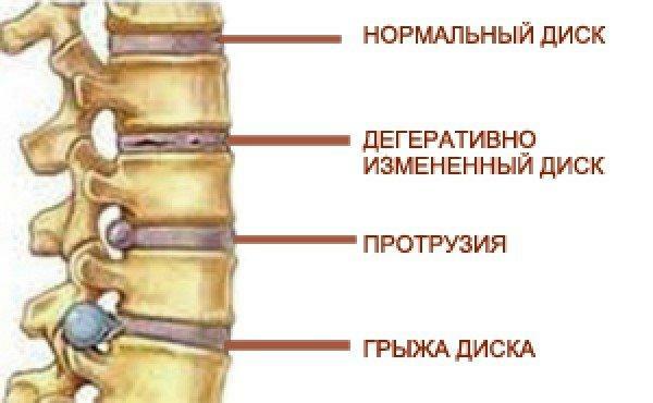Herniated disc of lumbar spine: treatment, symptoms