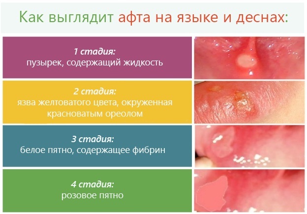 AftoFiks (AphtoFix) with an ulcer in the mouth. Price, instruction, analogs