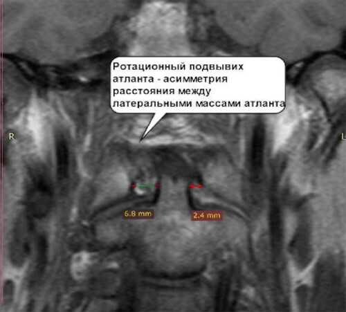 Subluxation of the cervical vertebra in a child. Symptoms, consequences