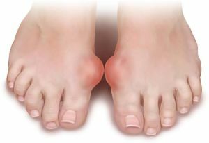 arthrose af big toe