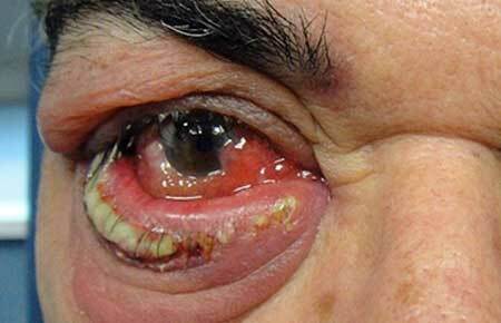 Purulente ontsteking van het ooglid, foto