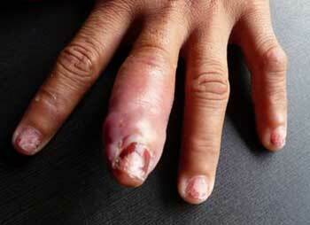 O dedo de Phlegmon, foto 5