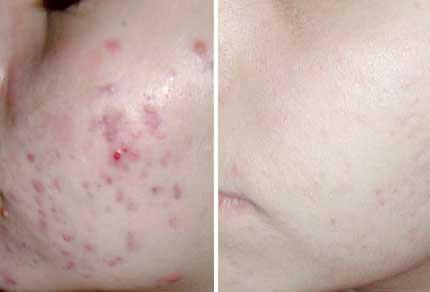 Skin before and after ultrasound