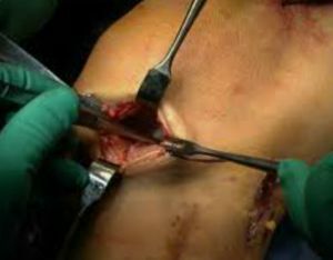 Operasi di lutut