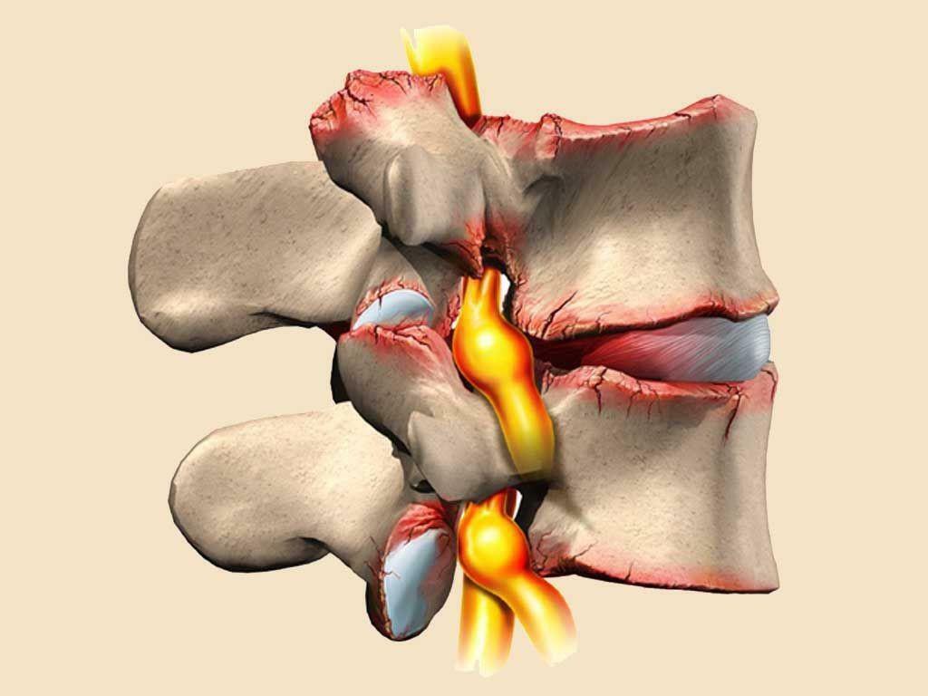 Osteokondroza kao uzrok migrene vrata maternice