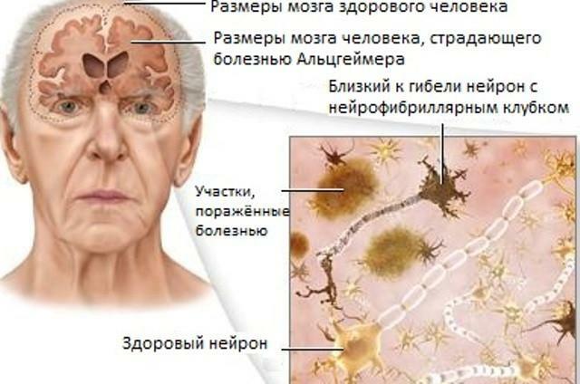 Shema oštećenja mozga
