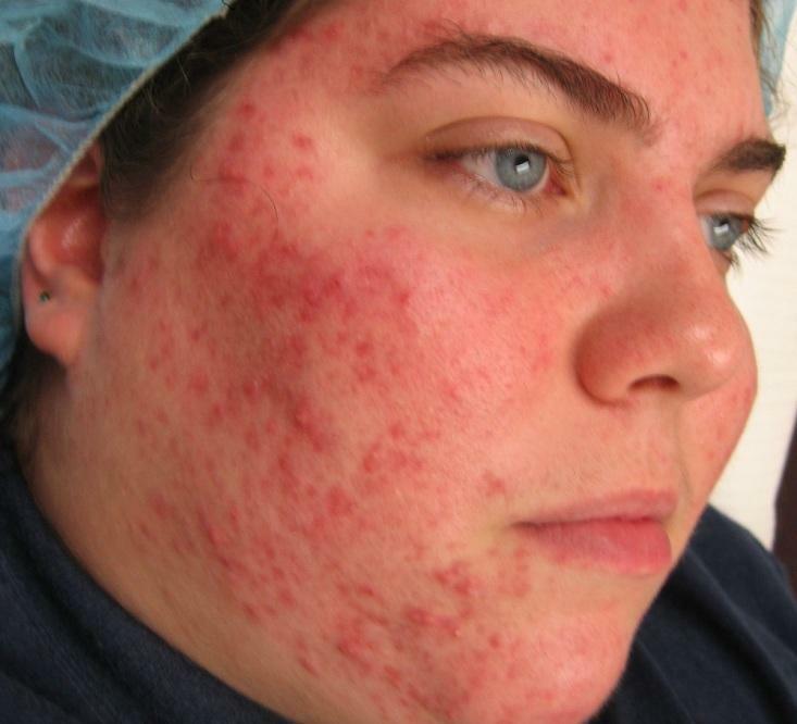 Manifestacije alergije na licu