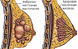 Vláknitá ferruginózna mastopatia: príznaky, liečba, prevencia