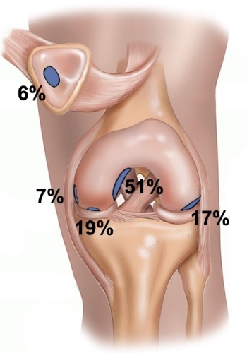 Enfermedad de König de la articulación de la rodilla. Qué es, tratamiento, etapas en niños, deportistas, adultos, cirugía
