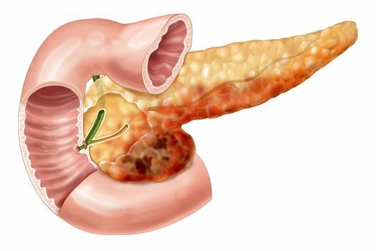 Terapeutisk fasting med pancreatitis