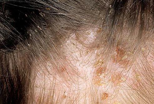 On close examination, you can see irritated areas of the skin and sores