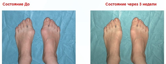 before and after using valgus pro