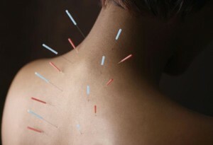 Acupuncture for problems with the spine
