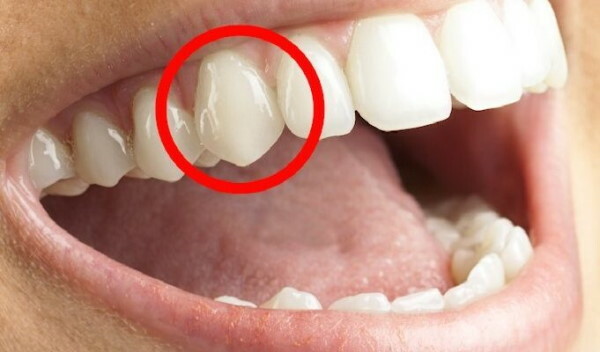 Eye tooth. Where is located, photos in children, adults, symptoms