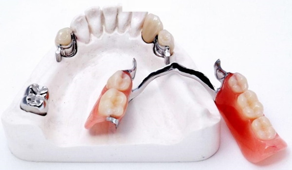 Kennedyn luokitus hampaiden puutteista. Ortopedia