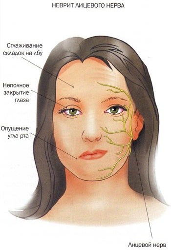 Neuralgia of the facial nerve. Symptoms and treatment, folk remedies, drugs