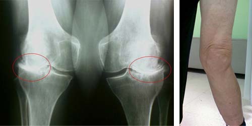 Osteoartrita articulației genunchiului de 3 grade