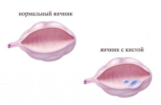 Perbedaan antara ovarium yang sehat dan ovarium dengan kista