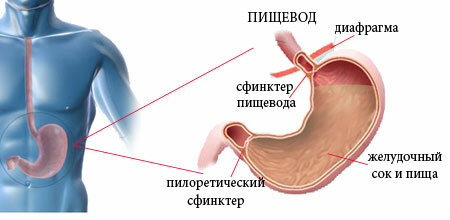 esofagita de reflux
