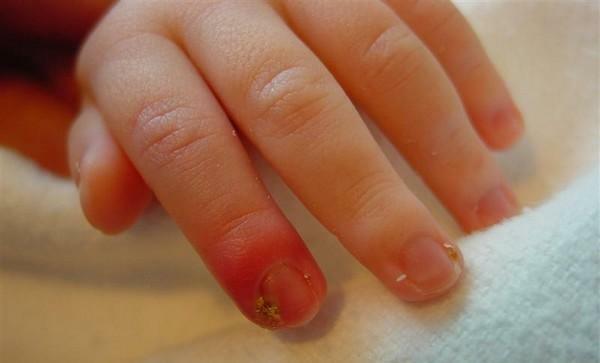Panaritium prsta na ruku: liječenje