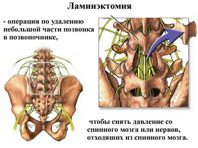 Laminectomy of the spine - an operation to remove a part of the vertebra