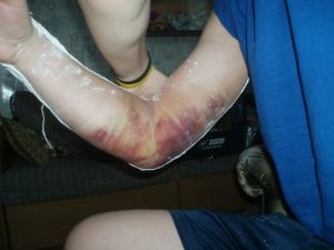 Elbow ligament injury