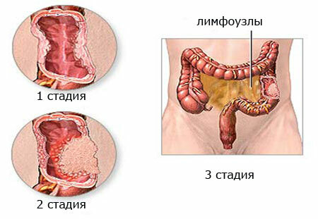 Estágio da foto do câncer intestinal