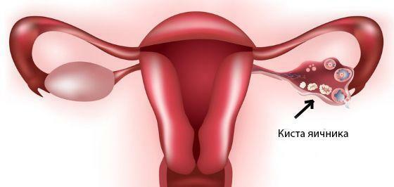 How to treat an ovarian cyst without surgery?