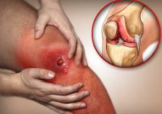 Infectious polyarthritis on the knee - photo