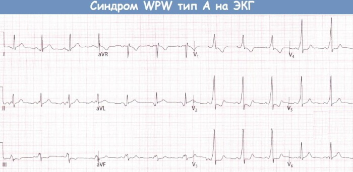 WPW (WPW) ECG syndrome. Signs that it is