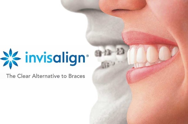 Aligners. What is it for teeth straightening, occlusion correction. Photos, prices, reviews