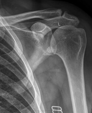 Les causes de la formation et le traitement des îlots osseux des énostoses