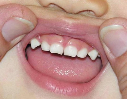 Mänskliga tänder. Typer, namn, anatomi, funktioner, foto