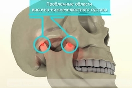 Arthrose de l'articulation de la mâchoire: traitement et diagnostic