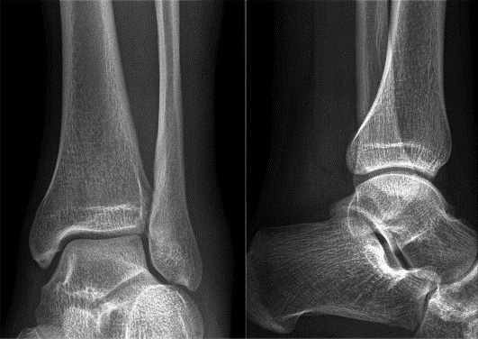 Ankle X-ray. What shows, photo, norm, preparation, price
