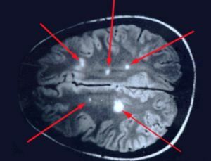 lesions in the brain