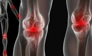 hemarthrosis of the knee