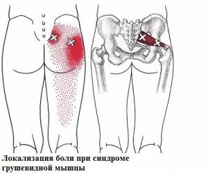 pain of the sciatic nerve