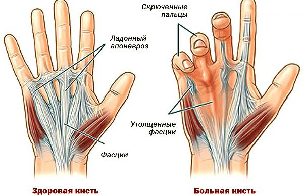 Menggigit jari di tangan. Apa itu, pengobatan tanpa operasi, pengobatan tradisional, alasan