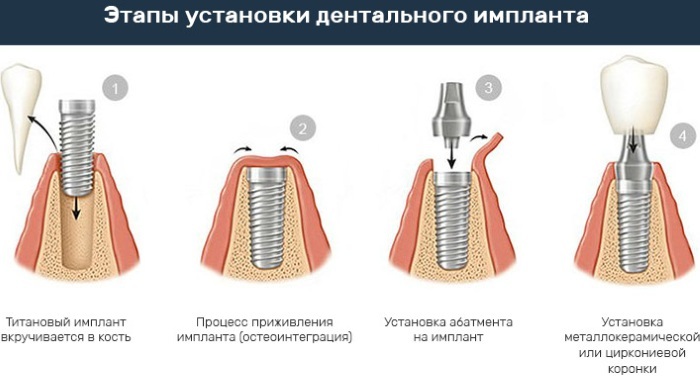 Implants Nobel Biocare. Manufacturer, turnkey price, reviews