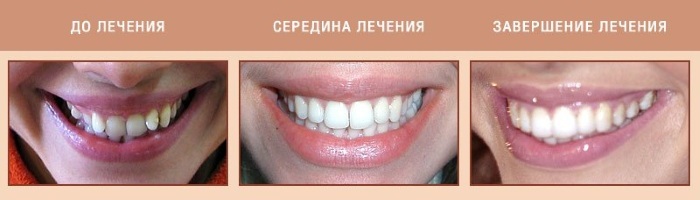 Aligners. What is it for teeth straightening, occlusion correction. Photos, prices, reviews