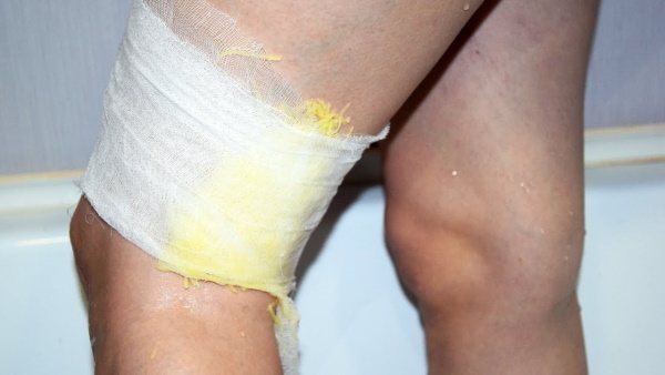 How to get rid of the mesh on the legs of the vascular, venous. Treatment