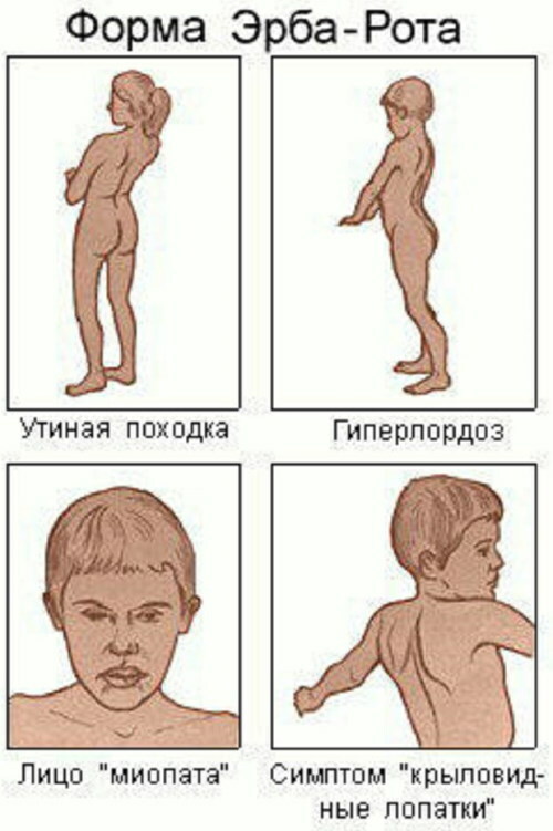 Myopathy. What is it, symptoms, causes, treatment