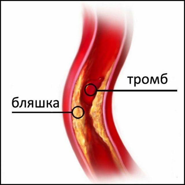 Ateroskleróza aorty