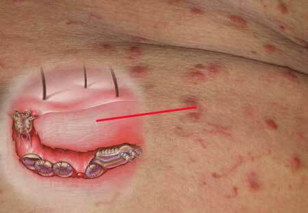 Scabies in adults
