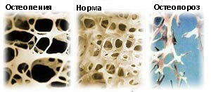 ontwikkeling van osteopenie